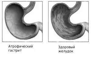 гастриту