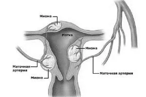 міома