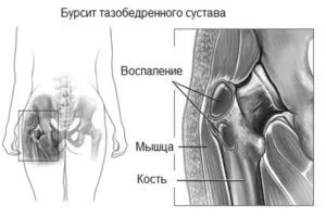 суглоба