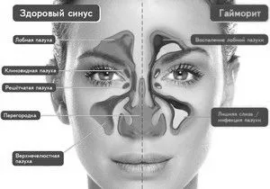 як лікувати хронічний грип