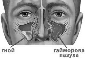 лікування гайморит симптоми дорослих як лікувати в домашніх умовах антибіотики ознаки як вилікувати профілактика