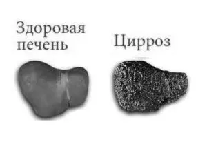як лікувати цироз печінку