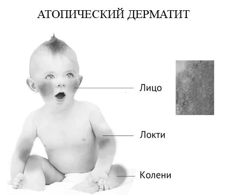 дерматит