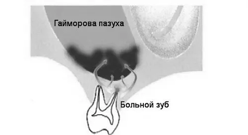 Що таке одонтогенний гайморит? Стоп риніт гайморит