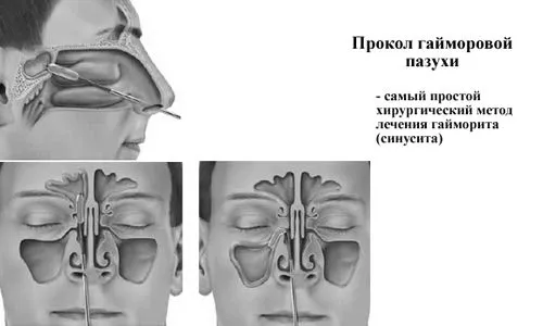 хронічний гайморит чим небезпечний