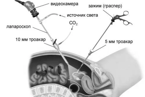 кіста