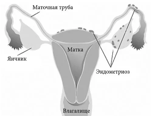 внутрішній ендометріоз лікування