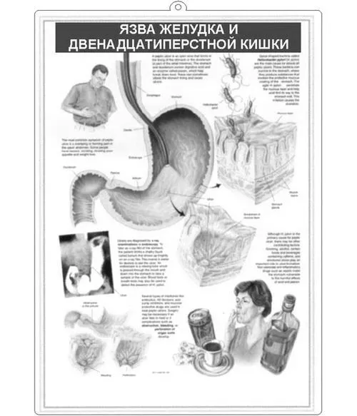 ерозивнийгастрит