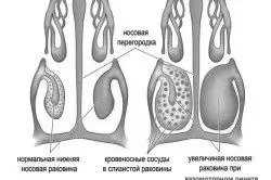 лікування риніту