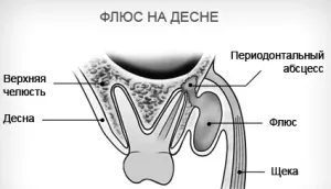 як лікувати флюс