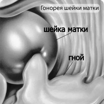ознаки захворювання тріпером
