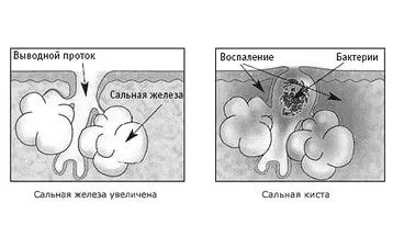 гнійні