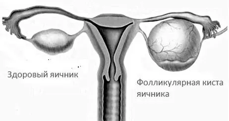 яєчника