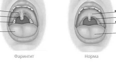 фарингіт