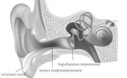як лікувати гнійний отит середнього вуха