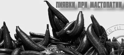 гірудотерапія