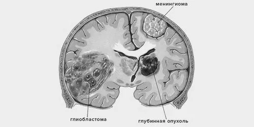 гліобластоми головного мозку