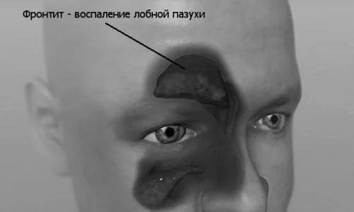 Фронтит: що це таке, симптоми, лікування у дорослих і дітей, антибіотики, наслідки, небезпека симптоми