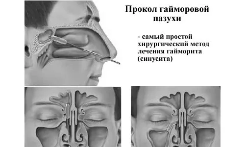 Фронтит: що це таке, симптоми, лікування у дорослих і дітей, антибіотики, наслідки, небезпека як лікувати фронтит при вагітності