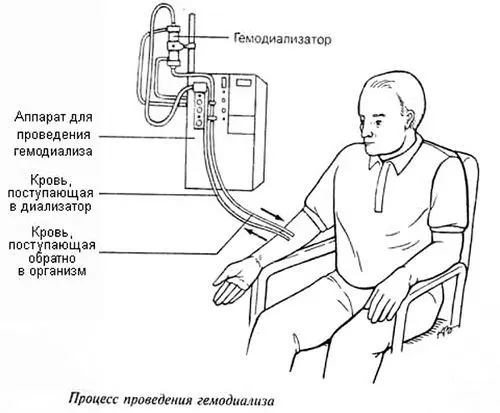 Гіпоплазія правої або лівої нирки причини лікування правої