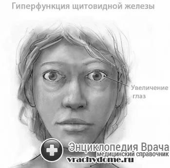 як вилікувати зоб назавжди