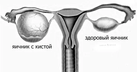 як лікувати лютеиновую кісту яєчника