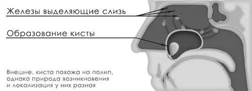 як лікувати кісту в гайморової пазухи
