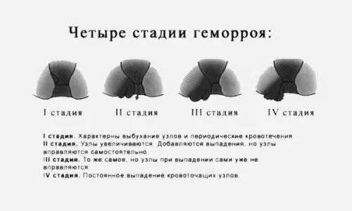 лікувати геморой на ранній стадії