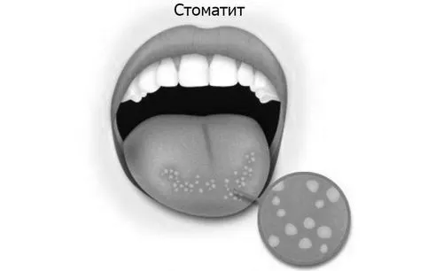 ангіну