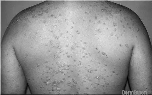 псоріаз guttate psoriasis