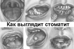 стоматиту
