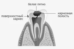 Лікування карієсу під час вагітності карієсу