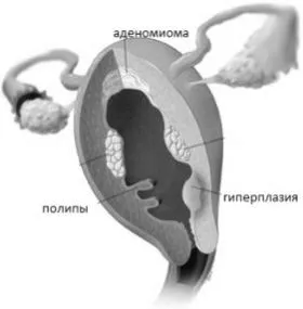чи можна лікувати ендометріоз шийки матки