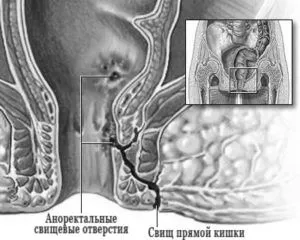 геморою