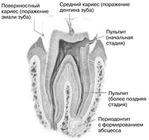 карієсу