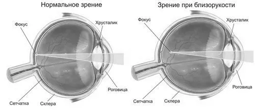 міопії