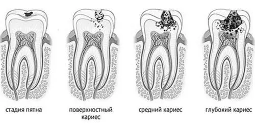 карієсу