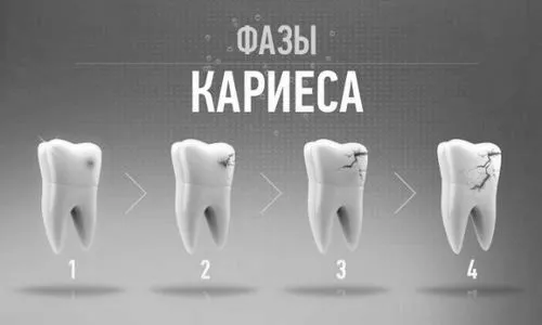 лікувати карієс без анестезії