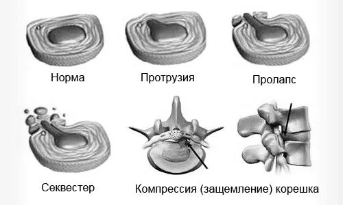 як лікувати шию народними засобами