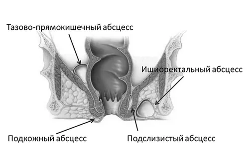 геморою