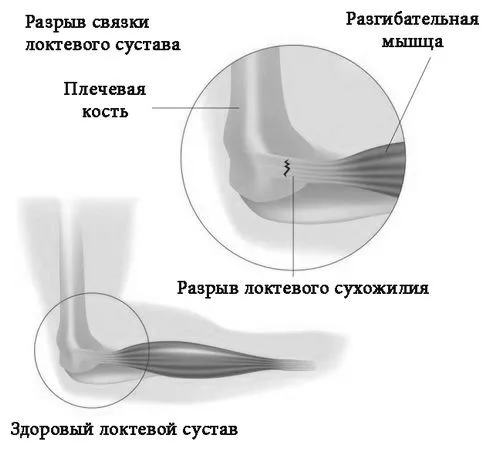 ліктьового