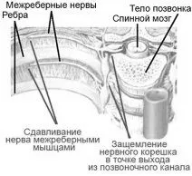міжреберна