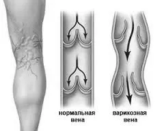 варикозу