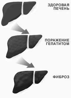 методи лікування гепатиту с