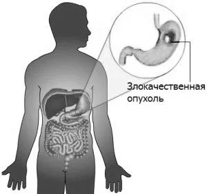 як лікувати хворобу рак