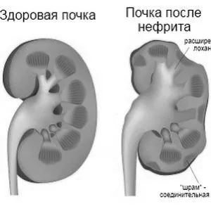Нефрит у дітей: причини, лікування, симптоми нефрит
