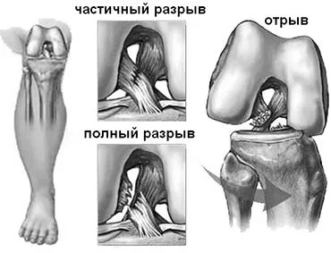 суглоба