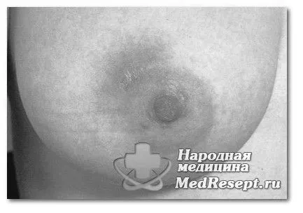 Містить лікування як лікувати мастит