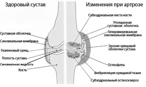 суглоба