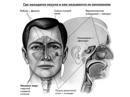 хронічний гайморит без нежиті